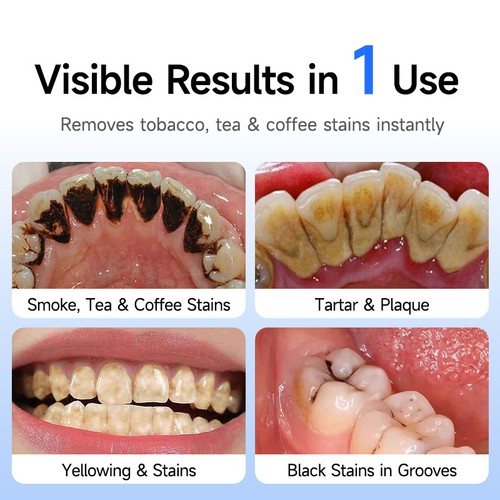 Electric tooth polisher plaque - electric,